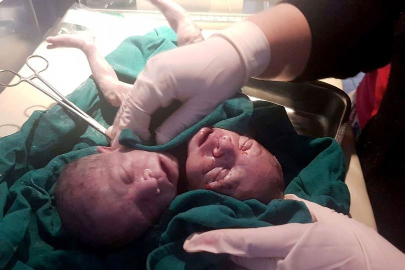 Hindistan çift başlı bebeğin şokunda - Resim: 2