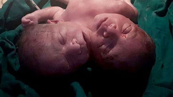Hindistan çift başlı bebeğin şokunda - Resim: 3