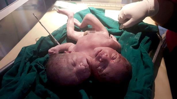 Hindistan çift başlı bebeğin şokunda - Resim: 4