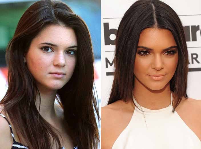 Kardashian ve Jenner ailesinin estetik sonrası değişimleri.. - Resim: 1