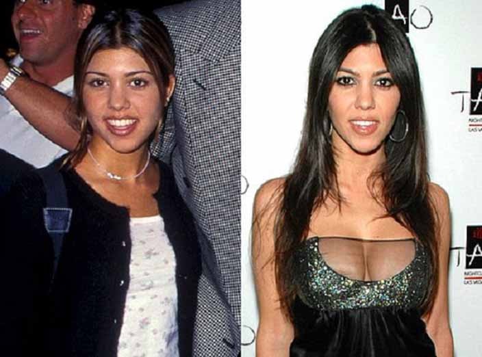 Kardashian ve Jenner ailesinin estetik sonrası değişimleri.. - Resim: 4