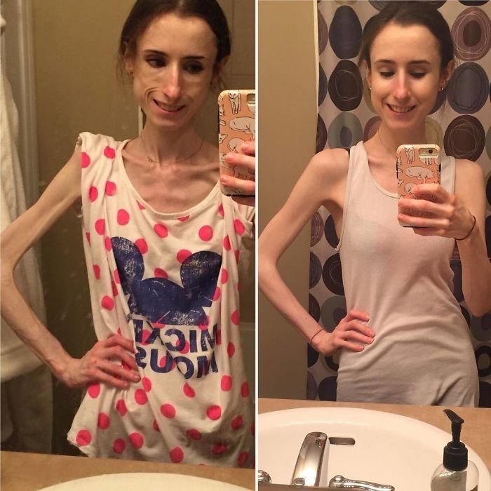 Anoreksiya hastalığına yakalanan kişilerin öncesi ve sonrası inanılmaz! - Resim: 1