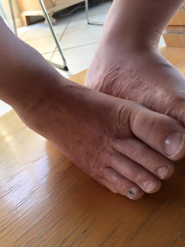 3 yaşındaki çocuk plajda oynarken ayak parmaklarını kaybediyordu - Resim: 3