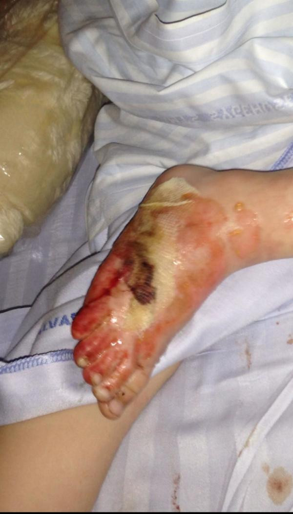 3 yaşındaki çocuk plajda oynarken ayak parmaklarını kaybediyordu - Resim: 4
