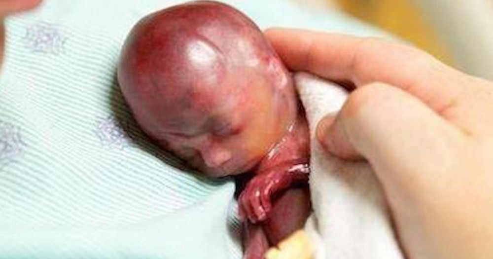 19 haftalıkken bebeği dünyaya geldi, kucağına aldığında... - Resim: 1