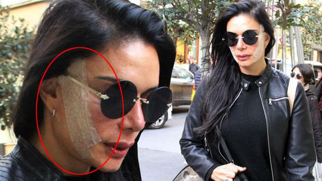Kim Kardashian'a benzemek istiyordu! Sevda Demirel'in yüzüne ne oldu? - Resim: 1
