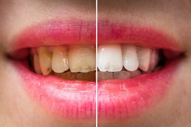 Dişlerinizi saniyeler içinde beyazlatacak ipuçları - Resim: 1