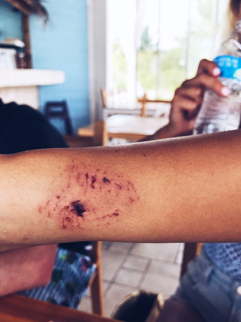 Instagram pozu verirken köpekbalığı kolunu ısırdı! - Resim: 3