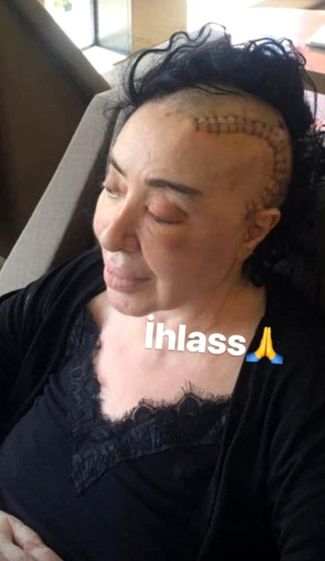 Beyin kanseriyle mücadele eden Nur Yerlitaş son haliyle korkuttu - Resim: 1