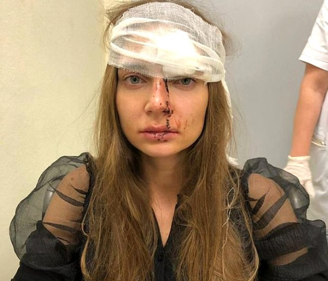Dudaklarına silikon yaptırmak isteyen Rus şarkıcı Valentina Sidorova'ya doktoru saldırdı! - Resim: 1