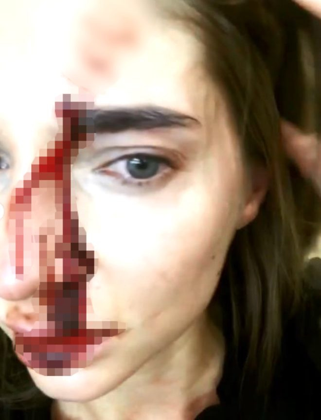 Dudaklarına silikon yaptırmak isteyen Rus şarkıcı Valentina Sidorova'ya doktoru saldırdı! - Resim: 2