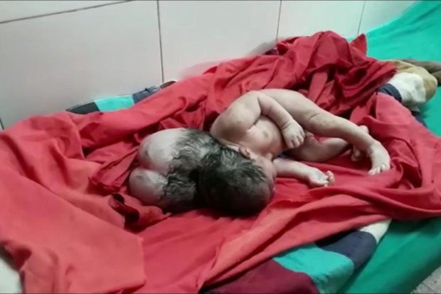 3 başlı doğan bebek görenleri şoke etti! - Resim: 1