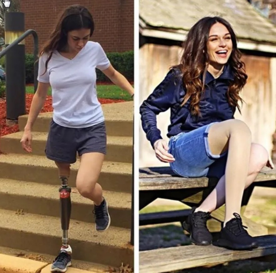 Tessa Snyder'ın 11 yaşında kanser yüzünden bacağı kesildi! Şimdi markalar peşinde koşuyor - Resim: 1