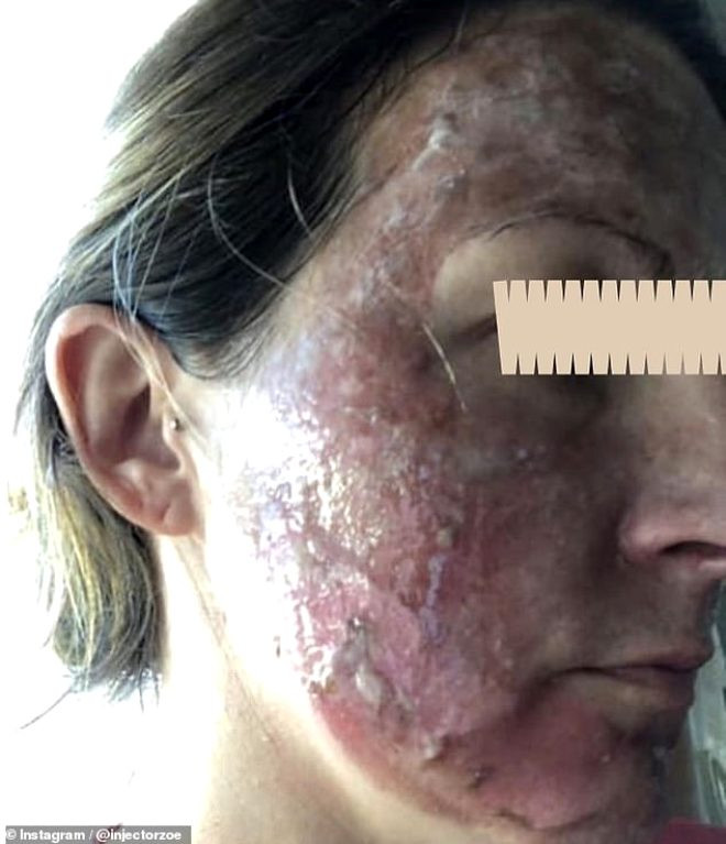 Cilt temizleme losyonu kullanan kadınların yüzleri yandı - Resim: 1