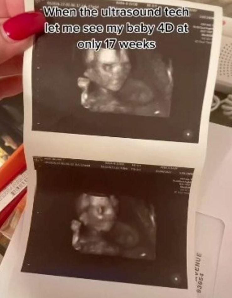 Hamile Kadının Ultrason Görüntüsü Görenleri Şok Etti: Beni Biraz Korkuttu! - Resim: 4