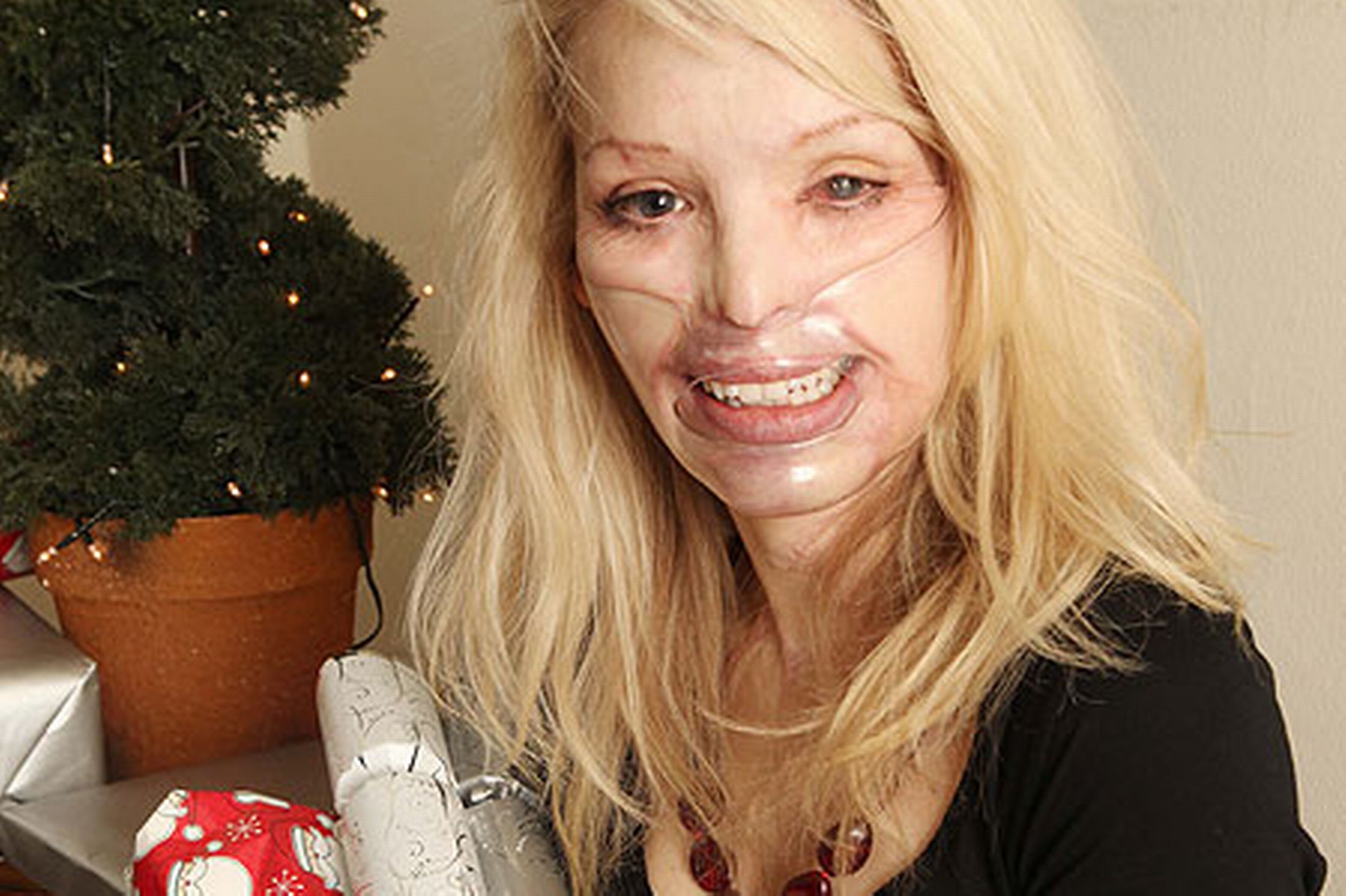 110 ameliyat geçirdi ama.. Katie Piper'in yeni yüzü - Resim: 4